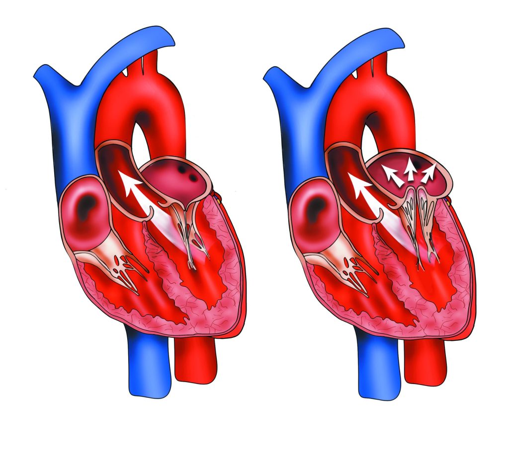 Heart valve disease - British Heart Valve Society