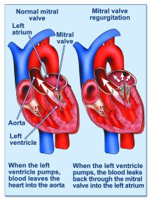 Mitral regurgitation - British Heart Valve Society