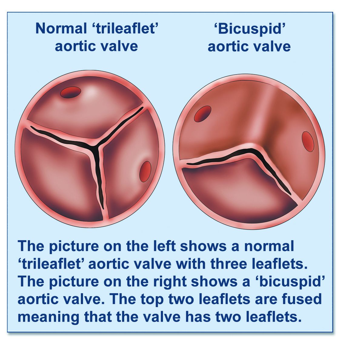 Bicuspid Aortic Valve British Heart Valve Society
